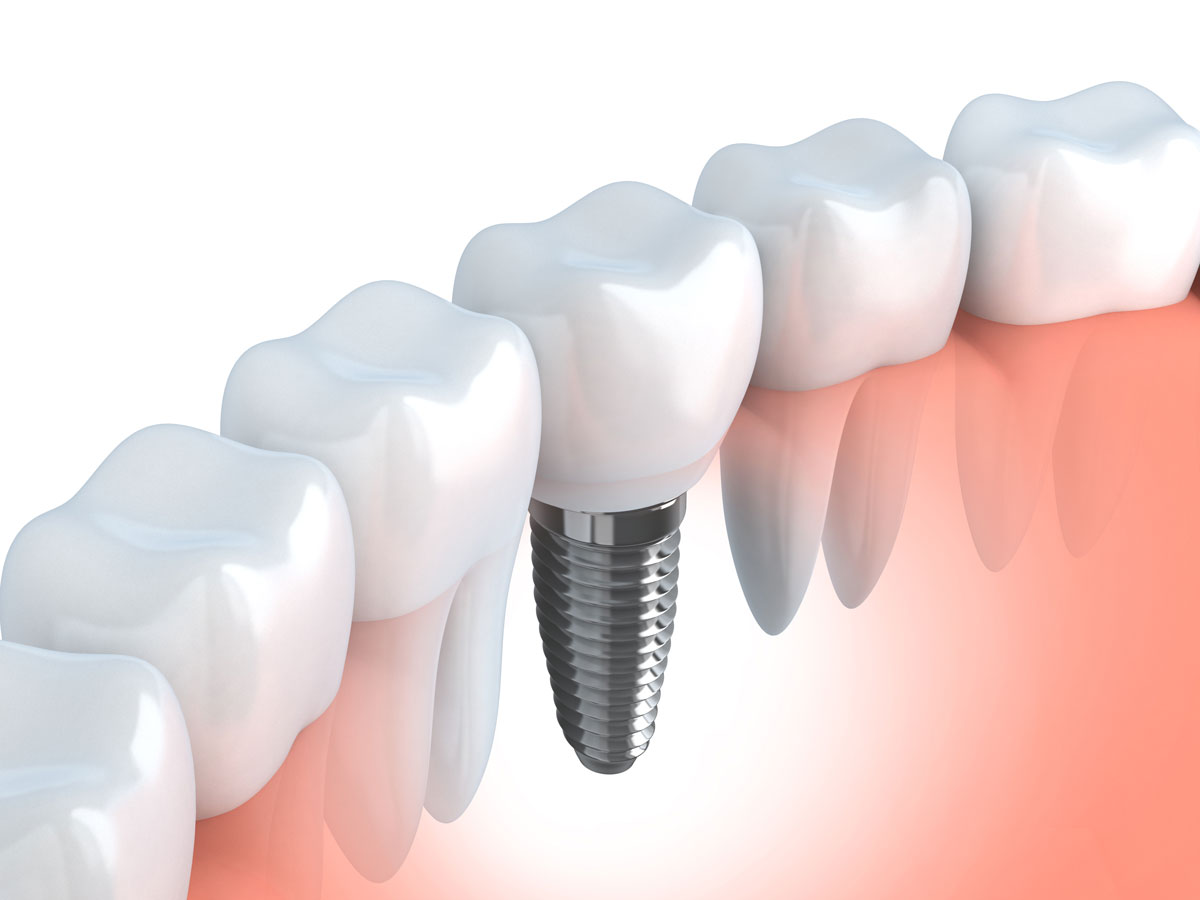 implantologia dentale ostia