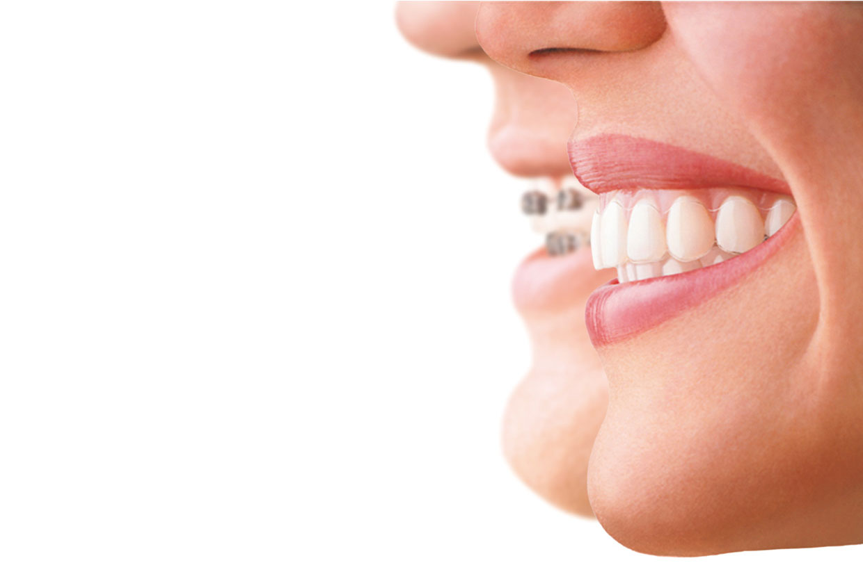 Invisalign